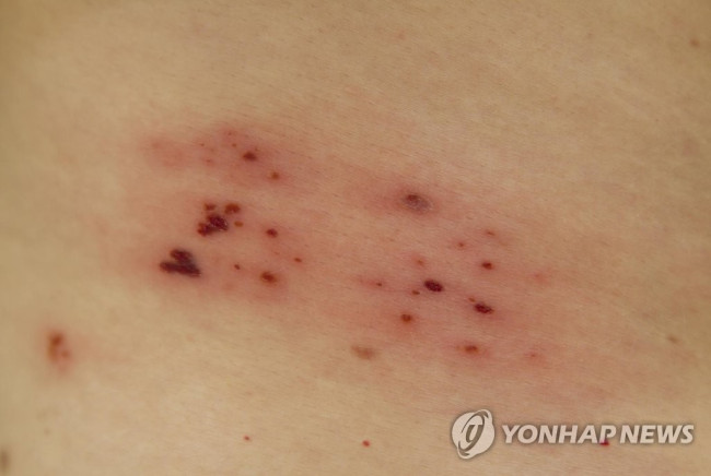 대상포진
