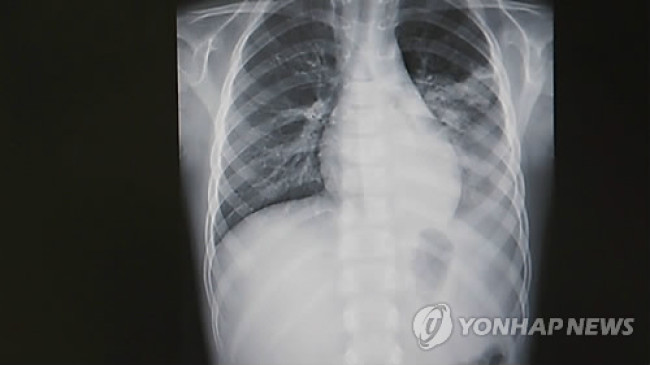폐렴 엑스레이