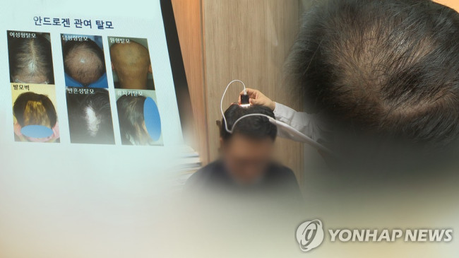 탈모 (CG)