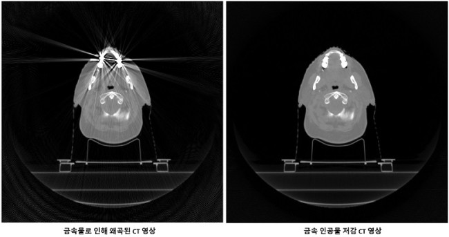 금속인공물에 의한 왜곡이 저감된 CT 영상(오른쪽)  