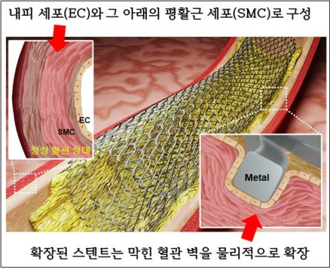 금속 스텐트 모식도