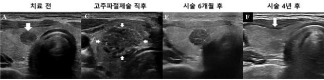 고주파절제술을 이용한 미세갑상선유두암 치료 과정