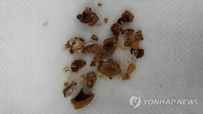 요로결석
