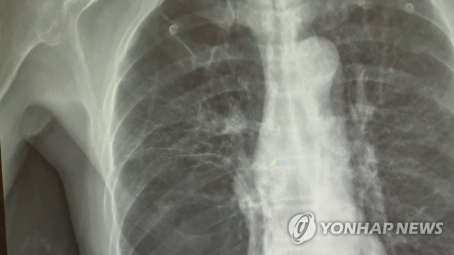 폐암 X-RAY