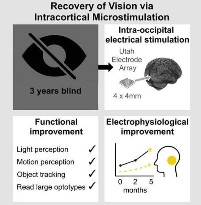 대뇌 시각피질 전기자극을 이용한 실명 환자 시각 회복 과정